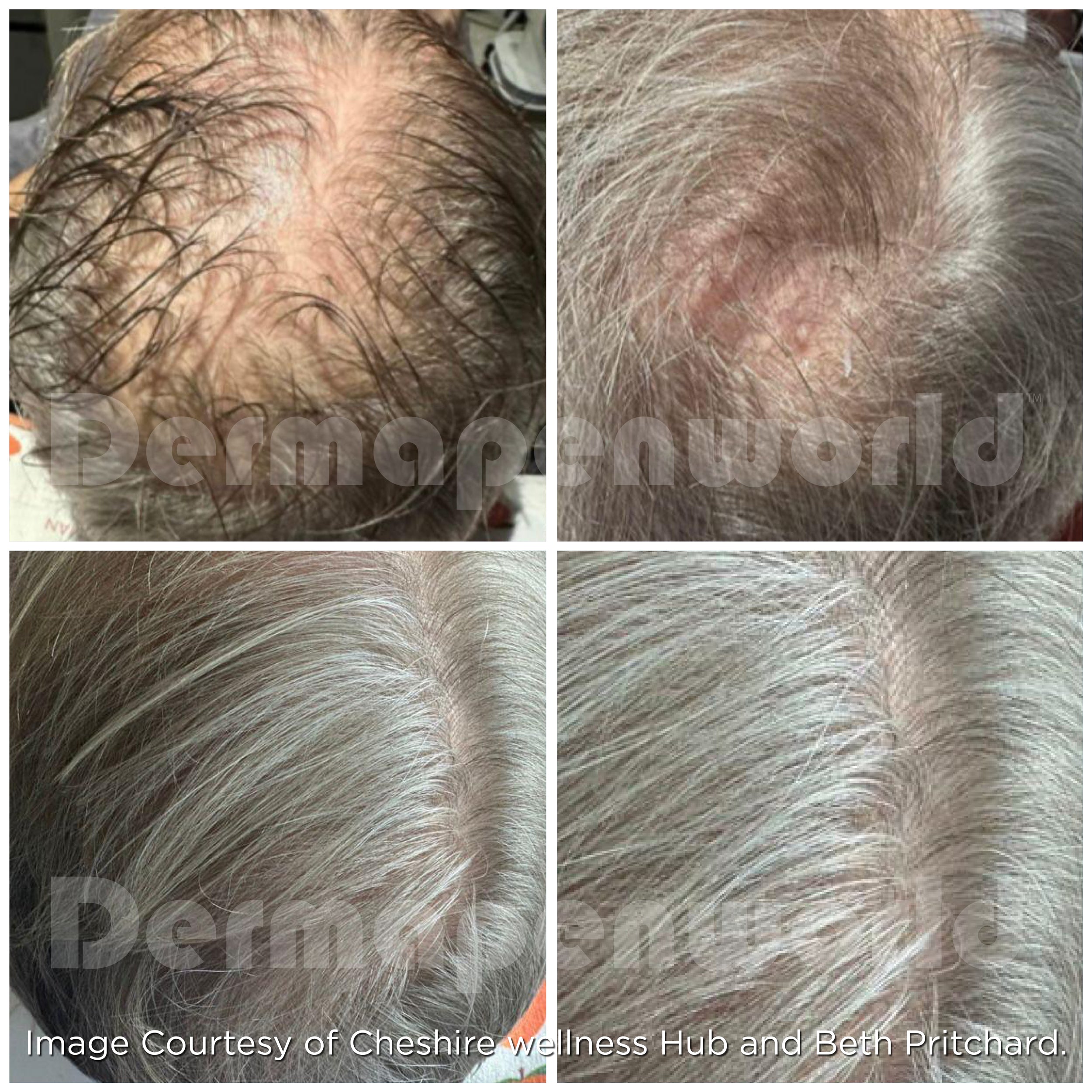 ghk-cu peptide typical dosage per day How Much GHK-Cu Should You Inject Daily? Doctor Explains